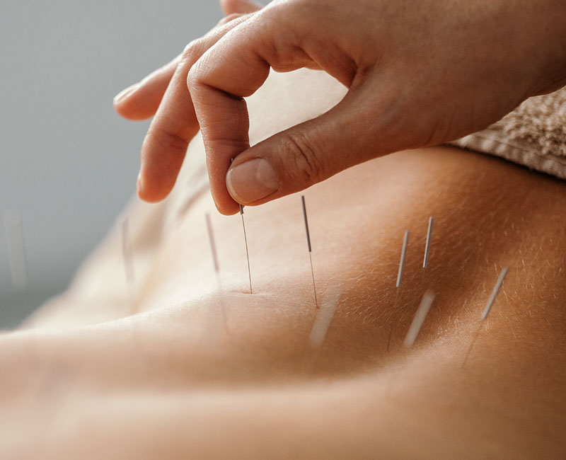 History of Acupuncture in America and the World